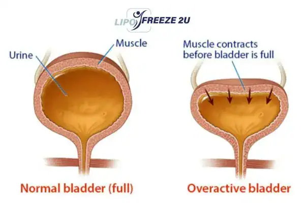 diagram of overactive bladder treatment Salford