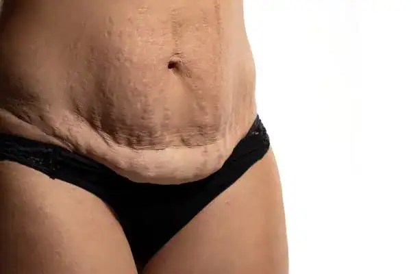 loose skin after weight loss injections Salford