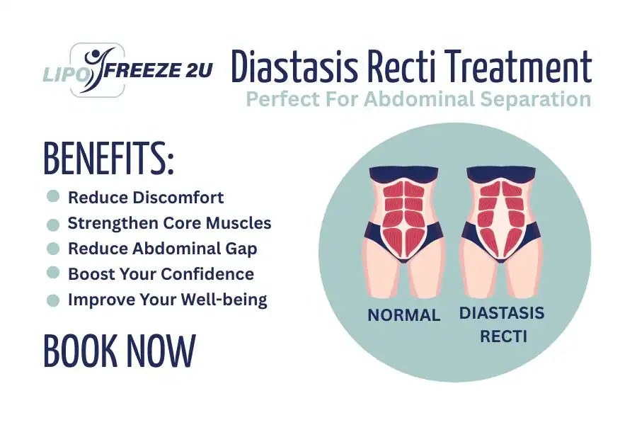 How Long Will It Take to See Improvements in Diastasis Recti Salford
