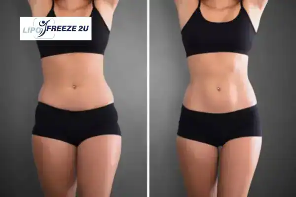 How Can LIPO FREEZE 2U Support Your Post-Pregnancy Body Recovery Salford?