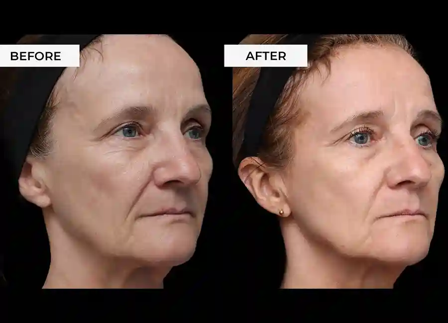 How Many RF Microneedling Sessions Will You Need to See a Difference Salford?